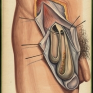 Teaching watercolor showing an oblique inguinal hernia where the two sacs are beside each other