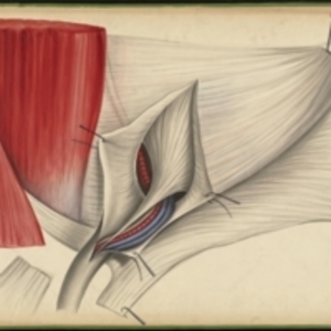 Teaching watercolor of the sheath of the fascia transversalis of the spermatic cord