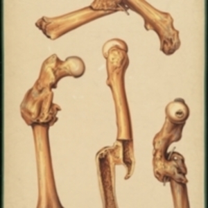 Teaching watercolor of four views of a badly healed fracture of the femur