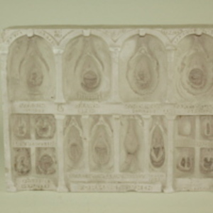 Dickinson-Belskie model of forms of hymen, 1946