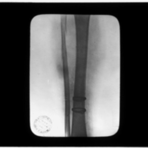 X-ray of surgical straps around tibia