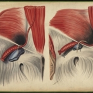 Teaching watercolor showing the circular dilation of the internal abdominal ring and the changed position of the epigastric artery caused by an inguinal hernia