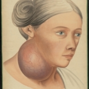 Teaching watercolor of woman with large growth on right side of neck under the ear and jaw