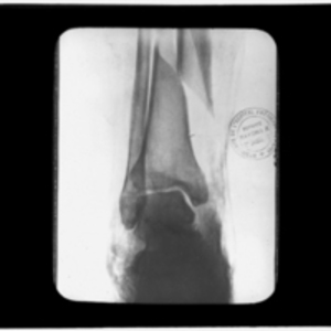 X-ray of sliced tibia