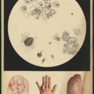 Teaching watercolor of a tumor removed from the ring finger of the left hand and a microscopic view of the tissue