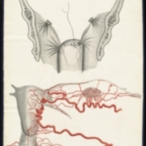 Teaching watercolor in black and white of surgical procedure with red watercolor detail of vessels