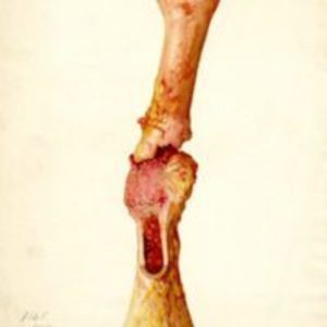 Colored drawing of fractured femur with cancerous growth