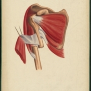 Teaching watercolor of a fracture of the shaft of the humerus