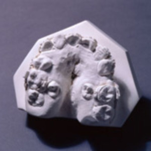 Dental cast illustrating a cleft palate