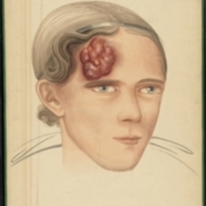 Teaching watercolor of a tumor on the forehead of a female patient