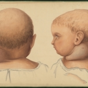 Teaching watercolor of hydrocele in the neck of an infant