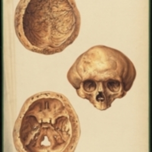 Teaching watercolor of a deformed skull