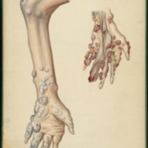 Teaching watercolor of tumors in the lower arm and hand