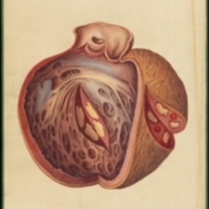 Teaching watercolor of degeneration of the heart tissue caused by venereal disease