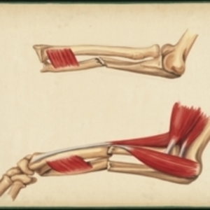 Teaching watercolor of fractures of the radius and ulna