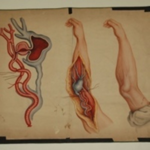 Teaching watercolor of aneurysm in arm, after Charles Bell's Practical Essays, 1848-1854
