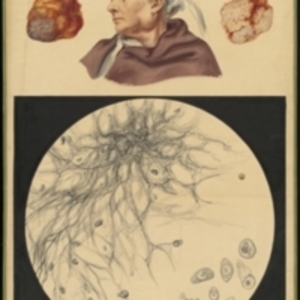Teaching watercolor of a mass removed from the jaw of a woman with a microscopic view of the tissue