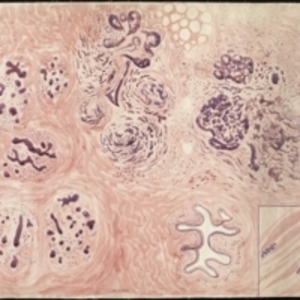 Teaching watercolor of microscopic view of scirrhous breast neoplasms