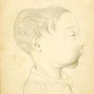 Pencil drawings of front and side view of head and face of child with sarcoma of the jaw
