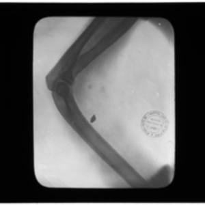 X-ray of shrapnel in limb