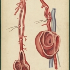 Teaching watercolor of an inguinal aneurysm and the femoral and popliteal arteries with a popliteal aneurysm