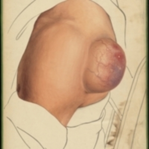 Teaching watercolor of large mass on the back of the left shoulder