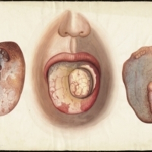 Teaching watercolor of cancer of the tongue