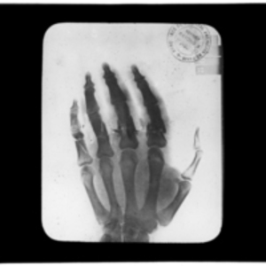 X-ray of hand with broken fingers
