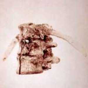 Left Lateral View of Vertebrae of President James A. Garfield