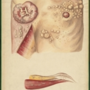 Large teaching watercolor of breast neoplasms in the skin and muscles of the breast