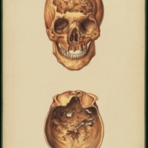 Teaching watercolor of a damaged skull