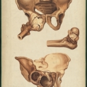 Teaching watercolor showing a damaged pelvis and femur
