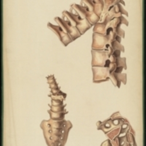 Teaching watercolor showing a severe bend in the spine with the ankylosis of five vertebrae and a healed spine that suffered from fracture and dislocation