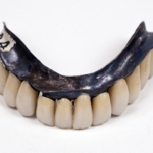 Superior and inferior silver metal dentures