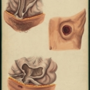 Teaching watercolor of various problems of the colon and natural artificial anus