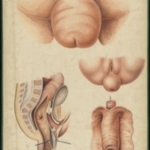 Teaching watercolor of four cases of intussusception of the intestines and rectum