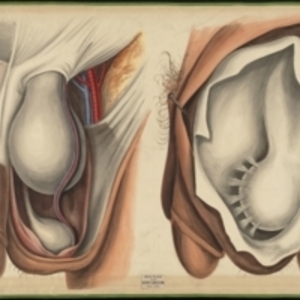 Teaching watercolor of the tunica vaginalis and the vessels of the spermatic cord from a scrotal hernia