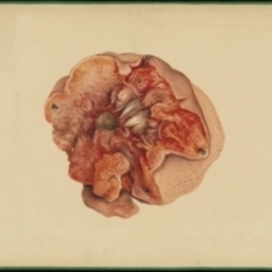 Teaching watercolor of the interior of a tumor