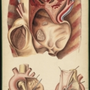 Teaching watercolor of an aneurysm of the aorta, trachea, and esophagus