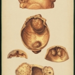 Teaching watercolor showing several views of tumors in the bone of the skull