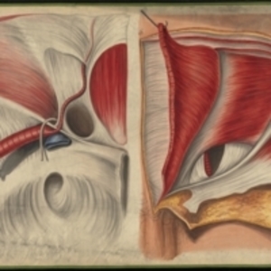 Teaching watercolor of the posterior wall of the inguinal canal and a view, from within, of the neck of the sac of a direct or internal inguinal hernia