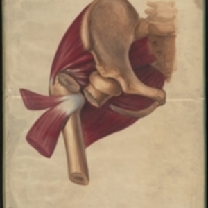 Teaching watercolor of a fracture of the femur between the shaft and the head near the hip