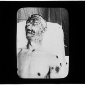 Patient with burns to face and shoulder wound