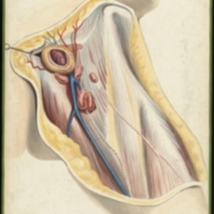 Teaching watercolor of a femoral hernia in a female patient