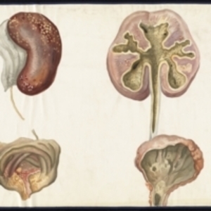 Teaching watercolor of interior and exterior of diseased kidney and bladder