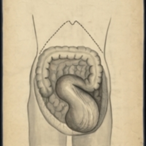 Teaching watercolor of a large growth on the colon