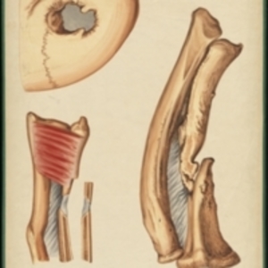 Teaching watercolor of a radius and tibia after fracture, and of a fracture of the cranium with a portion of the bone removed by a trephine