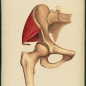 Teaching watercolor of a fracture of the great trochanter of the femur