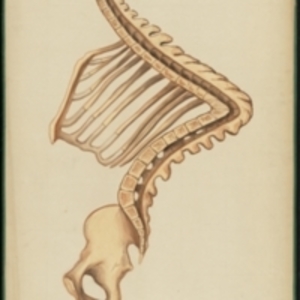 Teaching watercolor of an extremely distorted spine affected by scrophulous caries, cut away to show that the spinal canal is free and regular in its form despite the deformity
