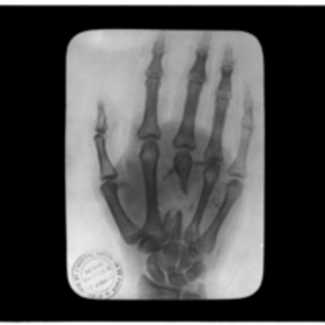 X-ray of hand with shattered metacarpal